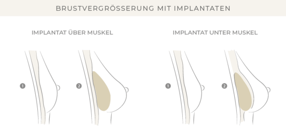 brustvergroesserung-bonn-dr-eugenia-remmel.png 