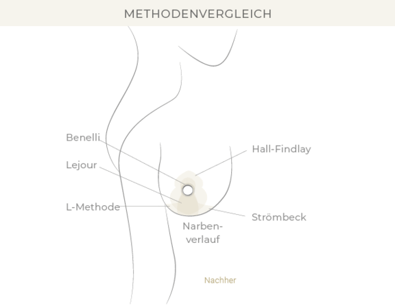 brustverkleinerung-bonn-dr-eugenia-remmel.png