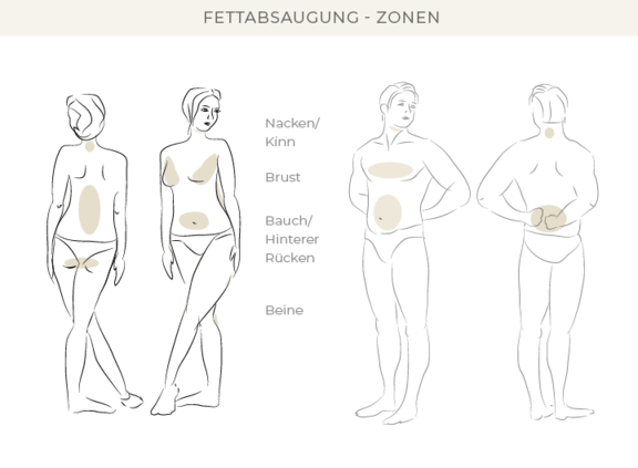 fettabsaugung-bonn-dr-eugenia-remmel.png